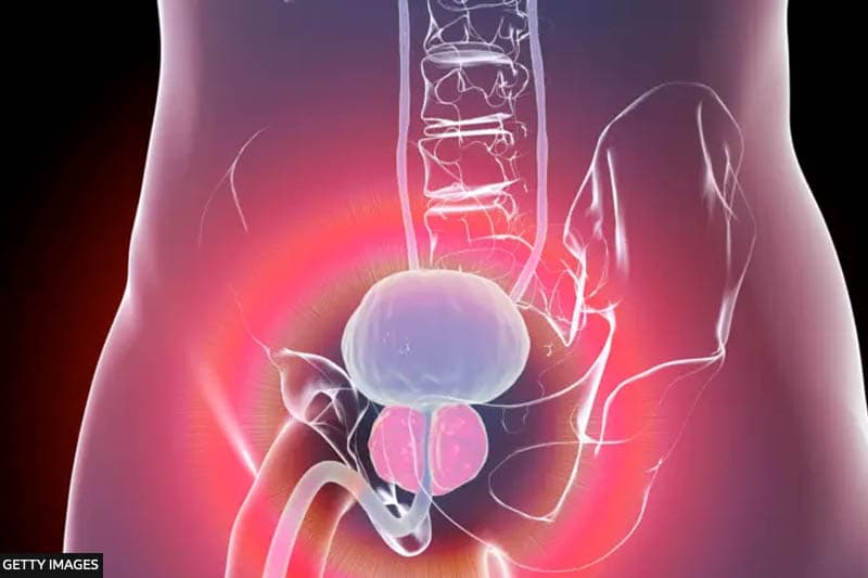 පුරස්ථි ග්‍රන්ථි පිළිකාව : 'කල් තියා ප්‍රතිකාර නොකිරීම ජීවිතයට තර්ජනයක්'