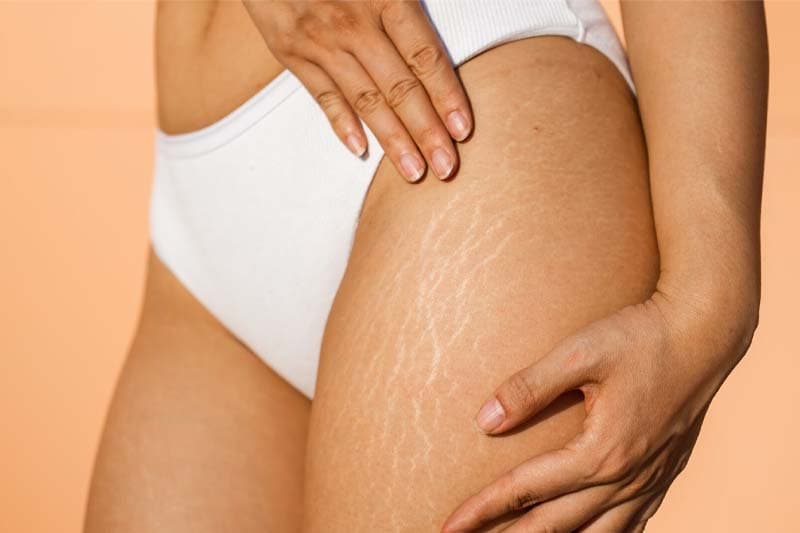 Stretch Marks යනු මොනවා ද? ඒවා සුව කළ හැකි ද?