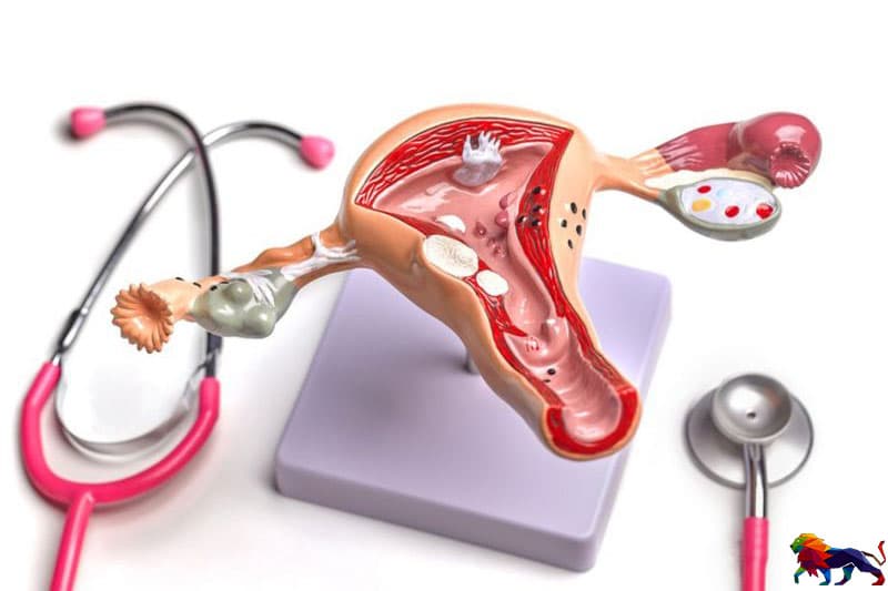 PCOS: සුව කළ නොහැකි නමුත්, වෛද්ය උපදෙස් සහ ප්රතිකාර අවශ්ය සුලභ රෝගය