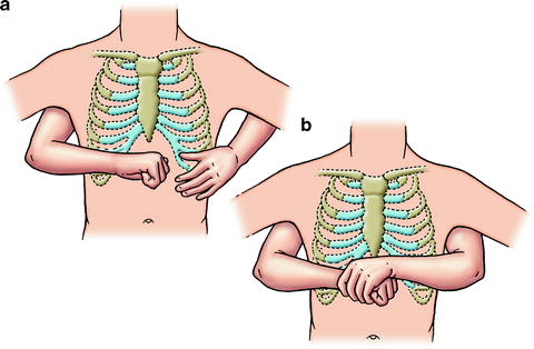 Abdominal Thrust Technique
