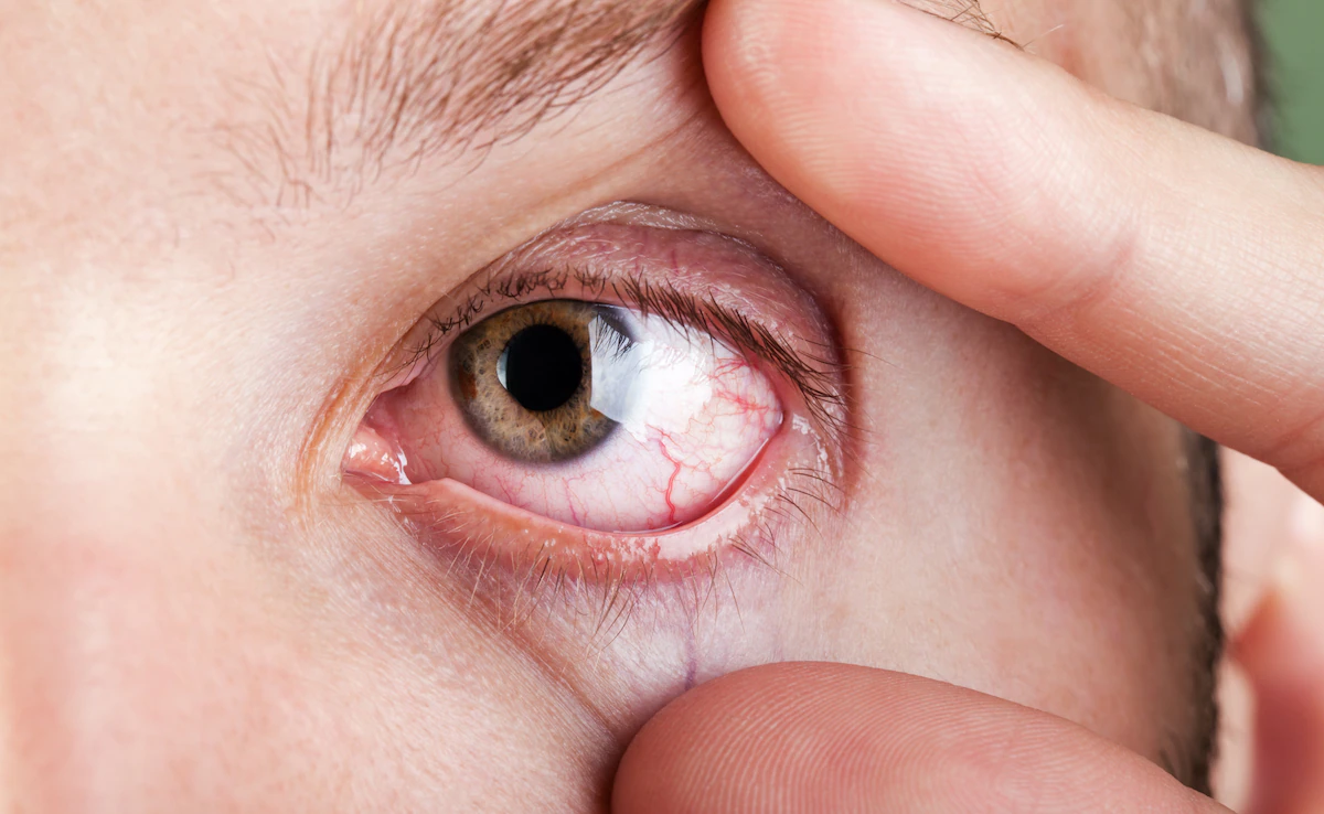 dry eyes