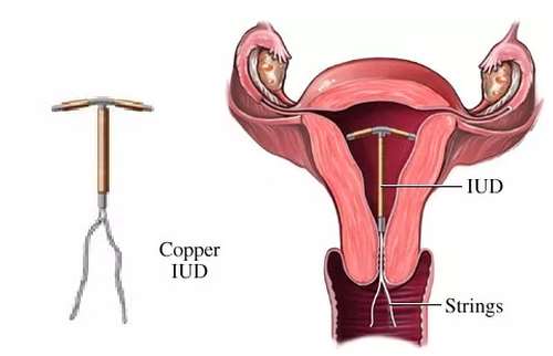 06 Copper IUD