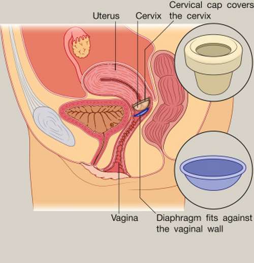 Obstetrics, Gynaecology & Reproductive Medicine, 22 (2012) 155-161. doi:10.1016/j.ogrm.2012.02.011